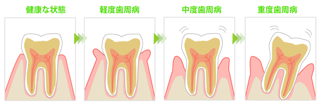 歯周病図